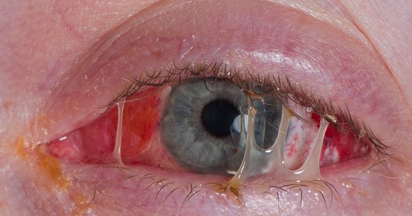 Viêm kết mạc có giả mạc là biến chứng đau mắt đỏ vô cùng nguy hiểm