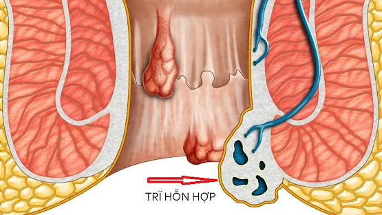 Trĩ hỗn hợp là gì?