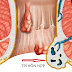 Trĩ hỗn hợp là gì? Phương pháp chữa trị mới nhất hiệu quả hiện nay