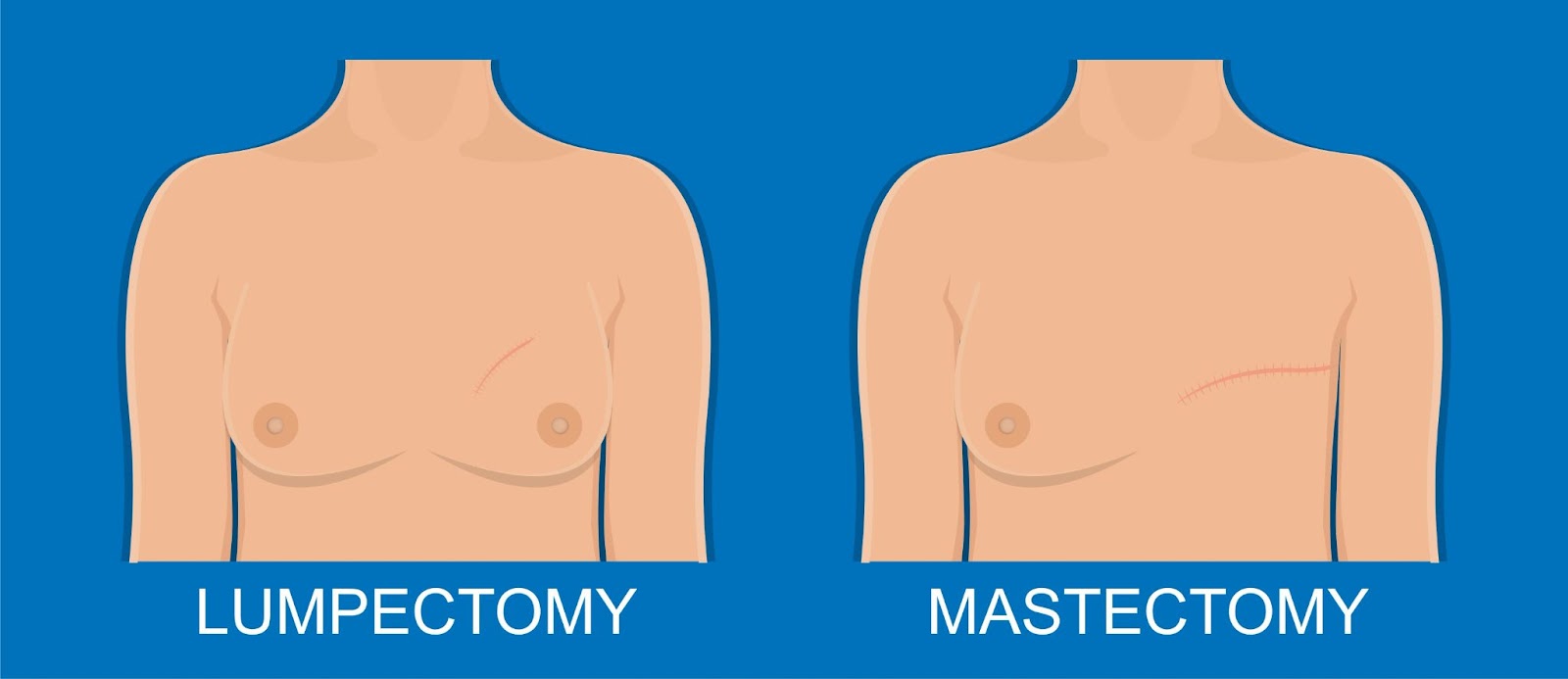 Lumpectomy vs. Mastectomy: Side-by-Side Comparison
