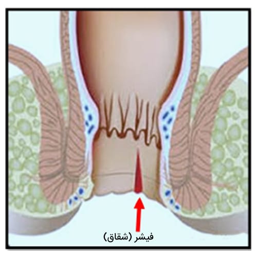 عکس بیماری فیشر