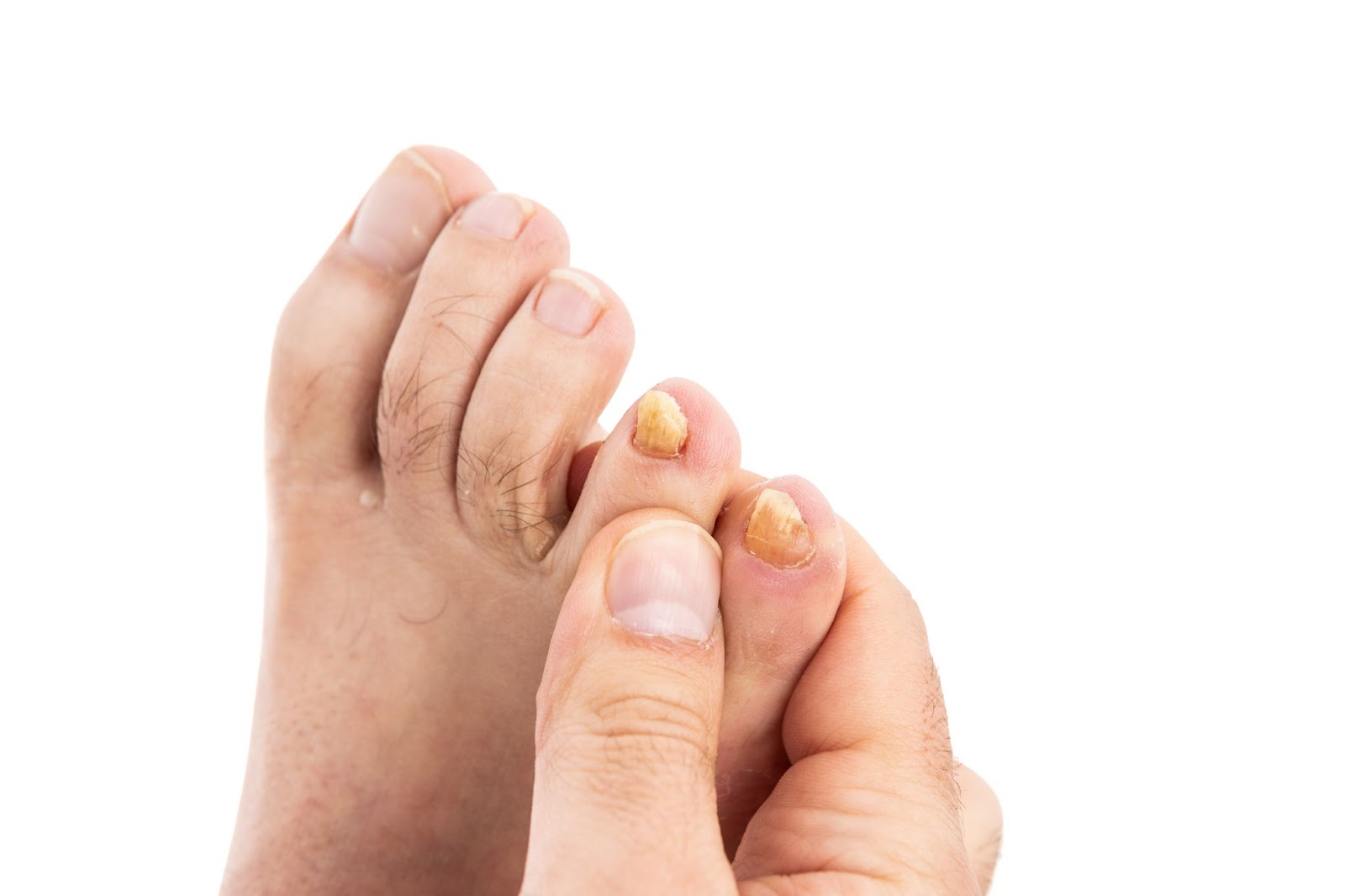 Fungal nails. We Fix Feet.