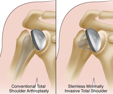 Shoulder Replacement Surgery (Arthroplasty) | Saroj Bone and Joint Clinic
