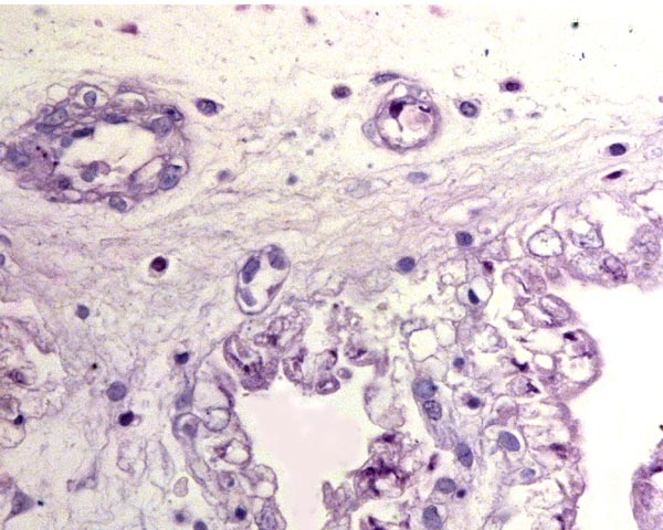 Tagua placenta of stillbirth, vacuolated trophoblast
