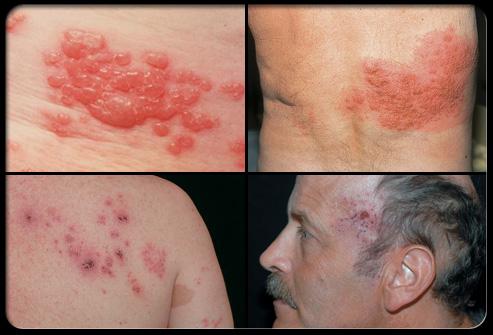 Here are examples of shingles blisters and rash.