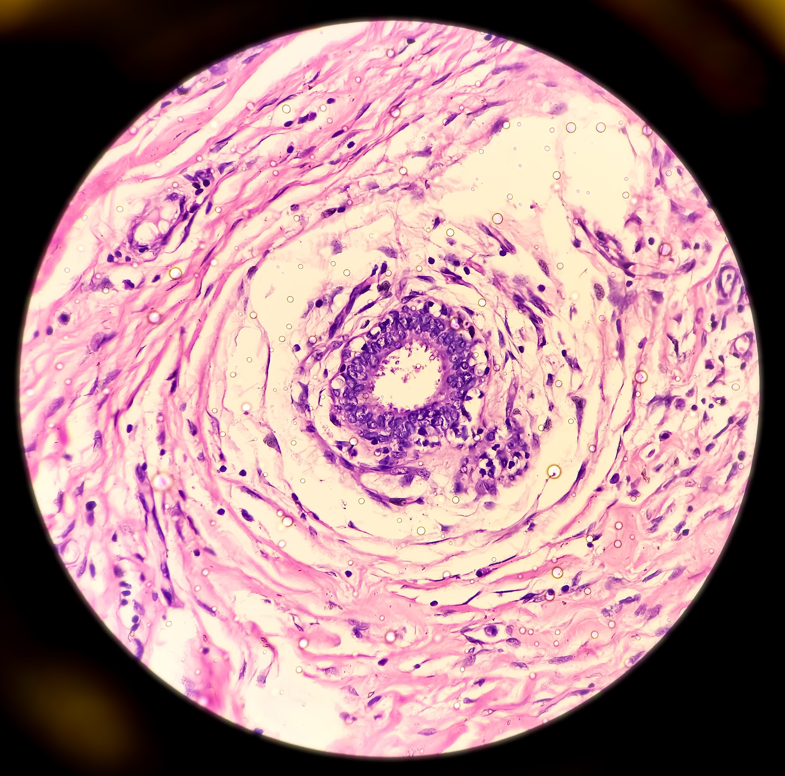 A microscopic view of Hidradenitis suppurativa ( HS ).
