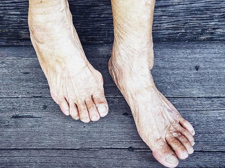 Osteoarthritis of ankle: Symptoms, treatment, exercises, surgery, and more