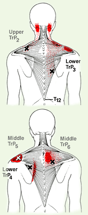 Trigger points located in the trapezius muscle