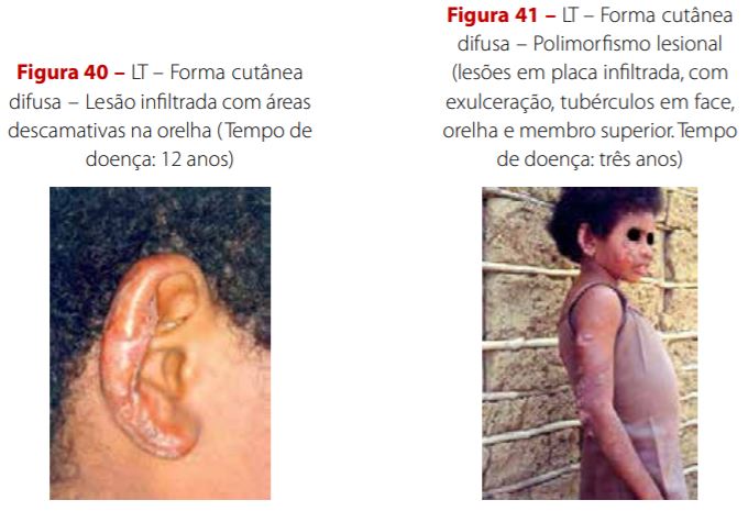 Imagem ilustrativa - tratamento da leishmaniose tegumentar