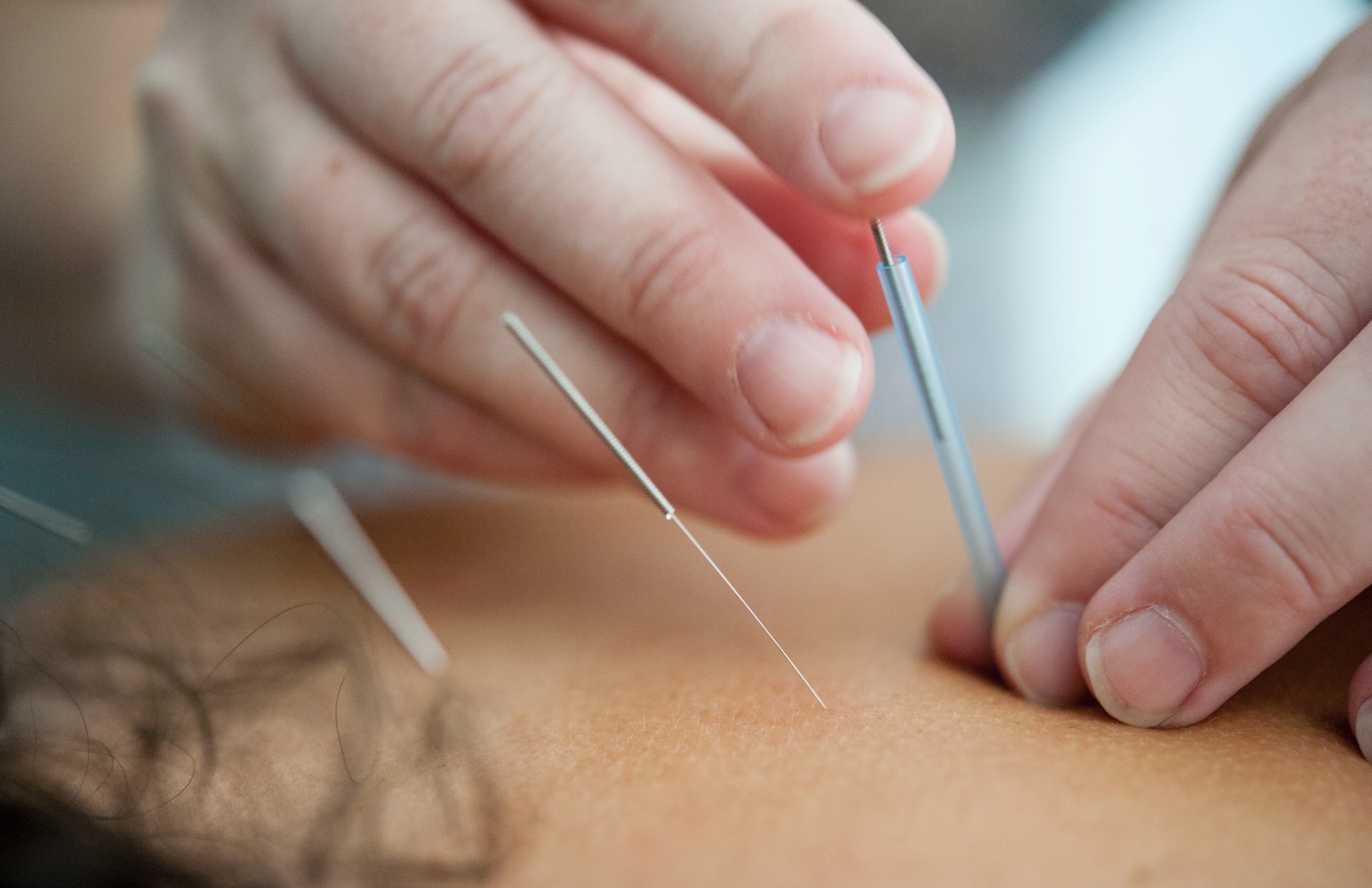 Acupuncture For Muscle Knots: Does It Work? | Lycoming Orthopedics & Sports  Acupuncture