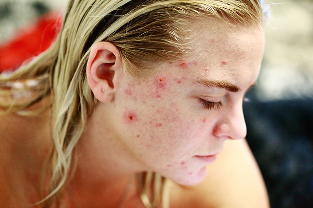 Fight acne on your face by applying oil and salicylic acid.