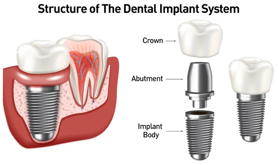 Structure of the dental implant system, illustrating crown, abutment, and implant body