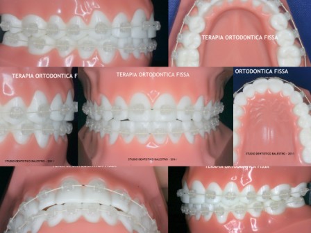 SDB - Terapia ortodontica fissa web.jpg