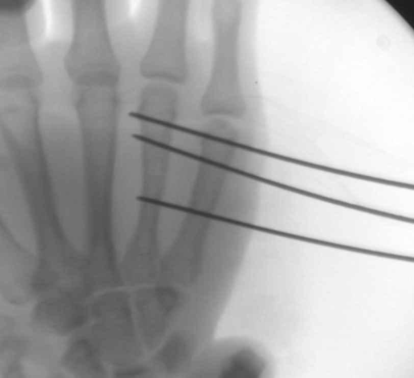 Finger Fracture Hand Fracture Treatment Raleigh hand Surgeon 