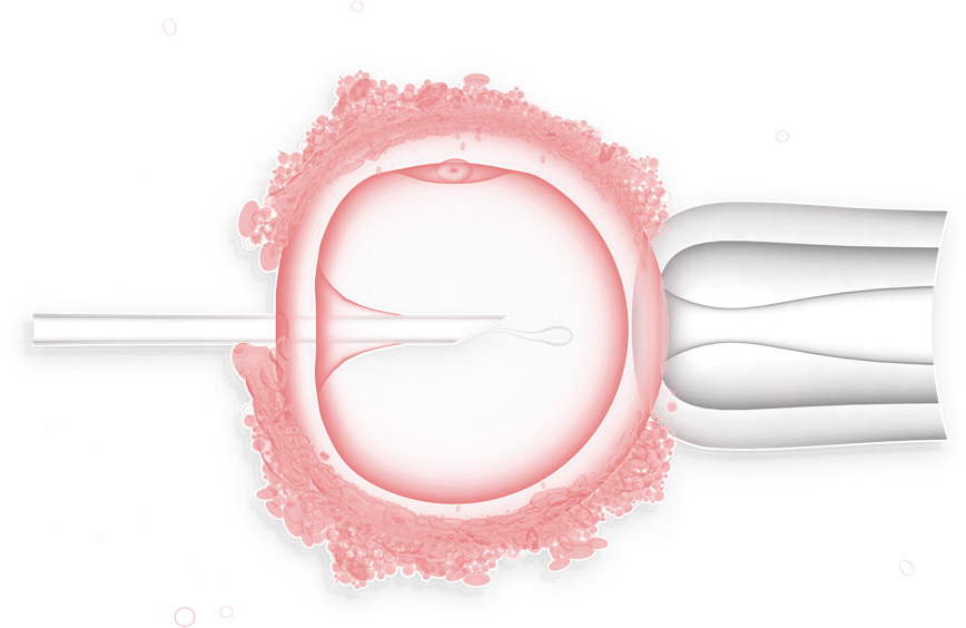 Сперматозоид вводится в яйцеклетку с помощью микрохирургических инструментов