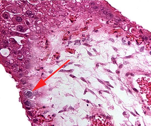 Tip of villus with binucleate cell at arrow and interdigitating fetal capillaries