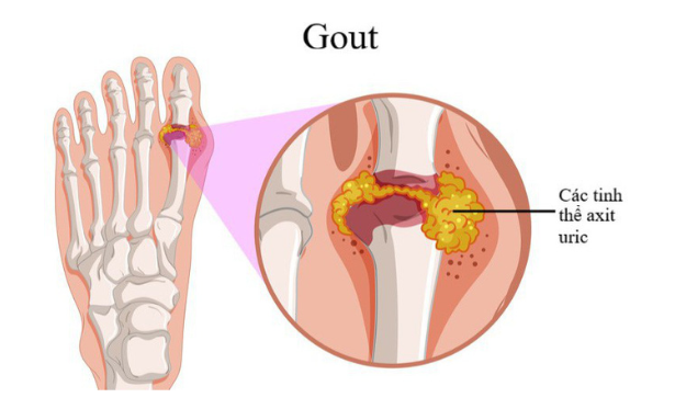 Bệnh Gout gây lắng đọng tinh thể acid uric
