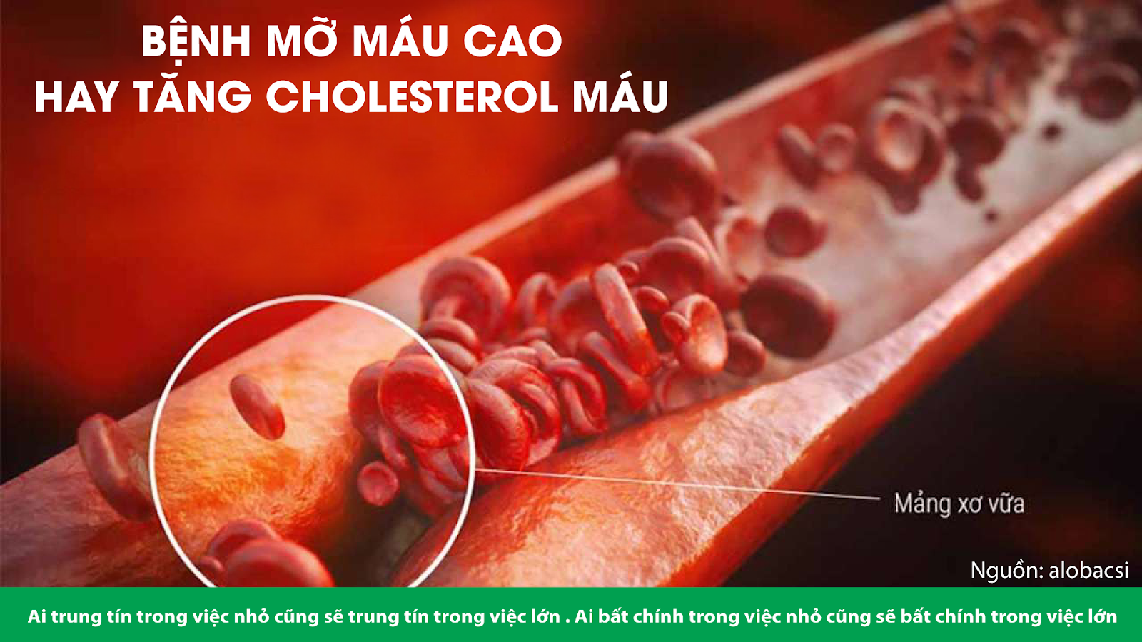 BỆNH MỠ MÁU CAO HAY TĂNG CHOLESTEROL MÁU