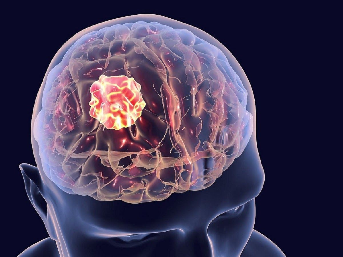 Ung thư não: nguyên nhân, triệu chứng và cách điều trị