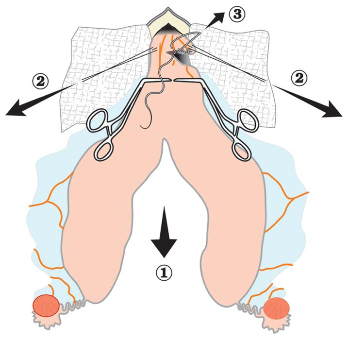 Surgery site with exteriorized uterus and ovaries, after transection of broad ligament and branches of ovarian and uterine arteries.
