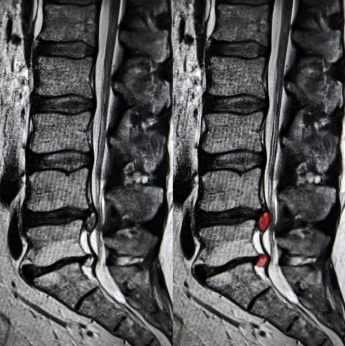 How to Read the MRI for a Herniated Disc and 5 Treatment Options