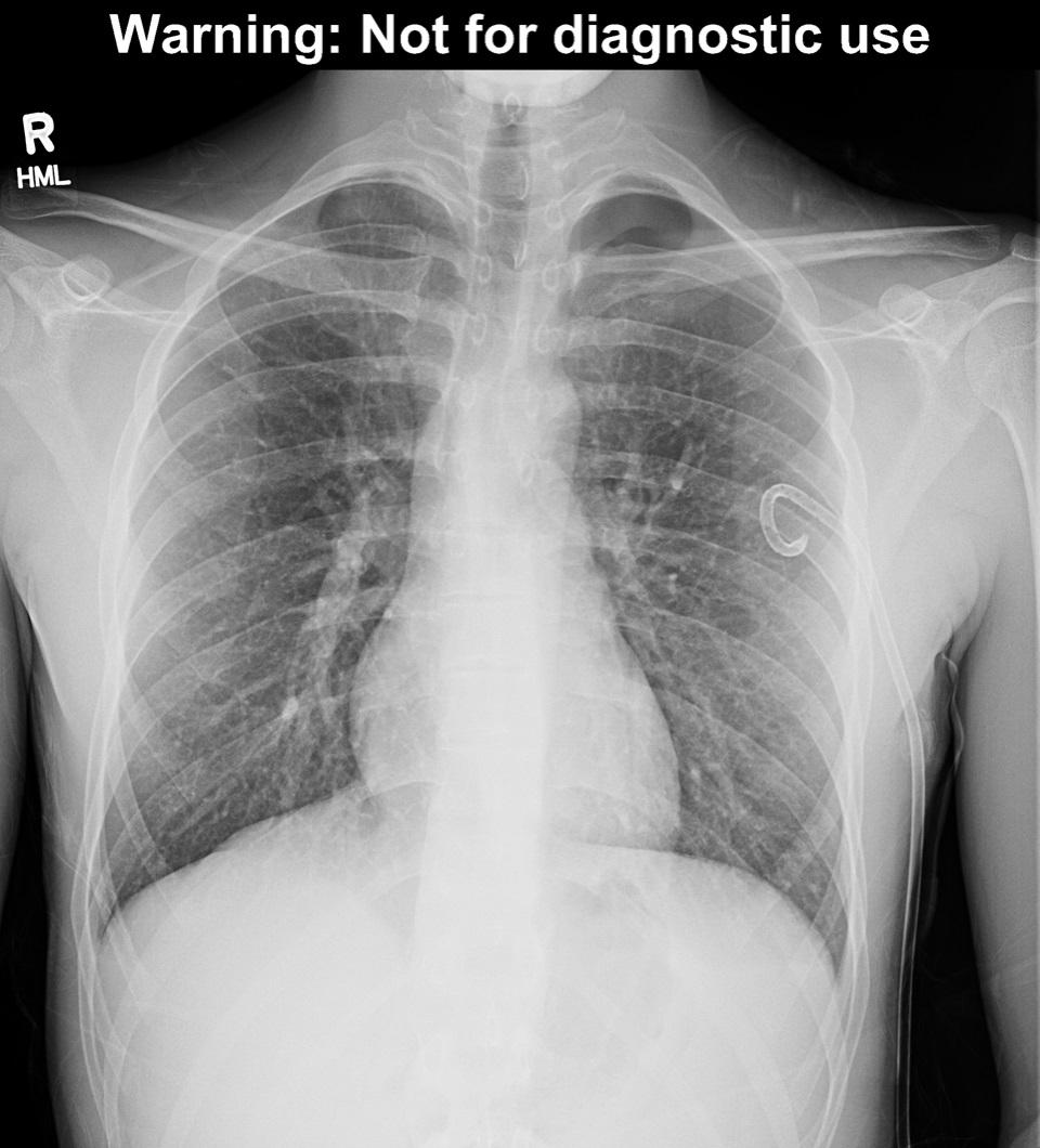 Pneumothorax