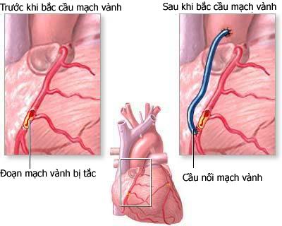 Kết quả hình ảnh cho phẫu thuật bắc cầu động mạch vành