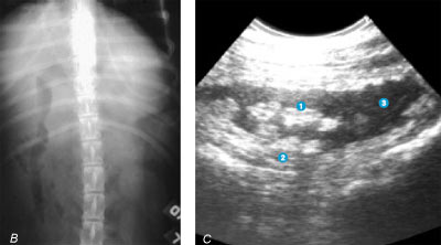 Radiographs (B) show a gas distended duodenum and a slight loss of abdominal detail consistent with peritonitis. An ultrasound is performed that shows an enlarged hypoechoic pancreas (C) and a small amount of free abdominal fluid.