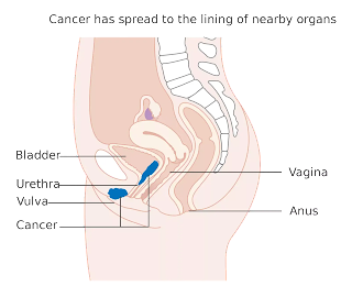 What is Vulvar Cancer