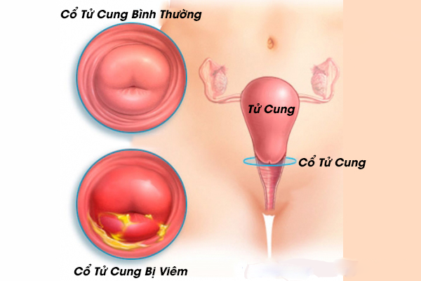 khí hư màu trắng đục có thể là dấu hiệu của viêm cổ tử cung