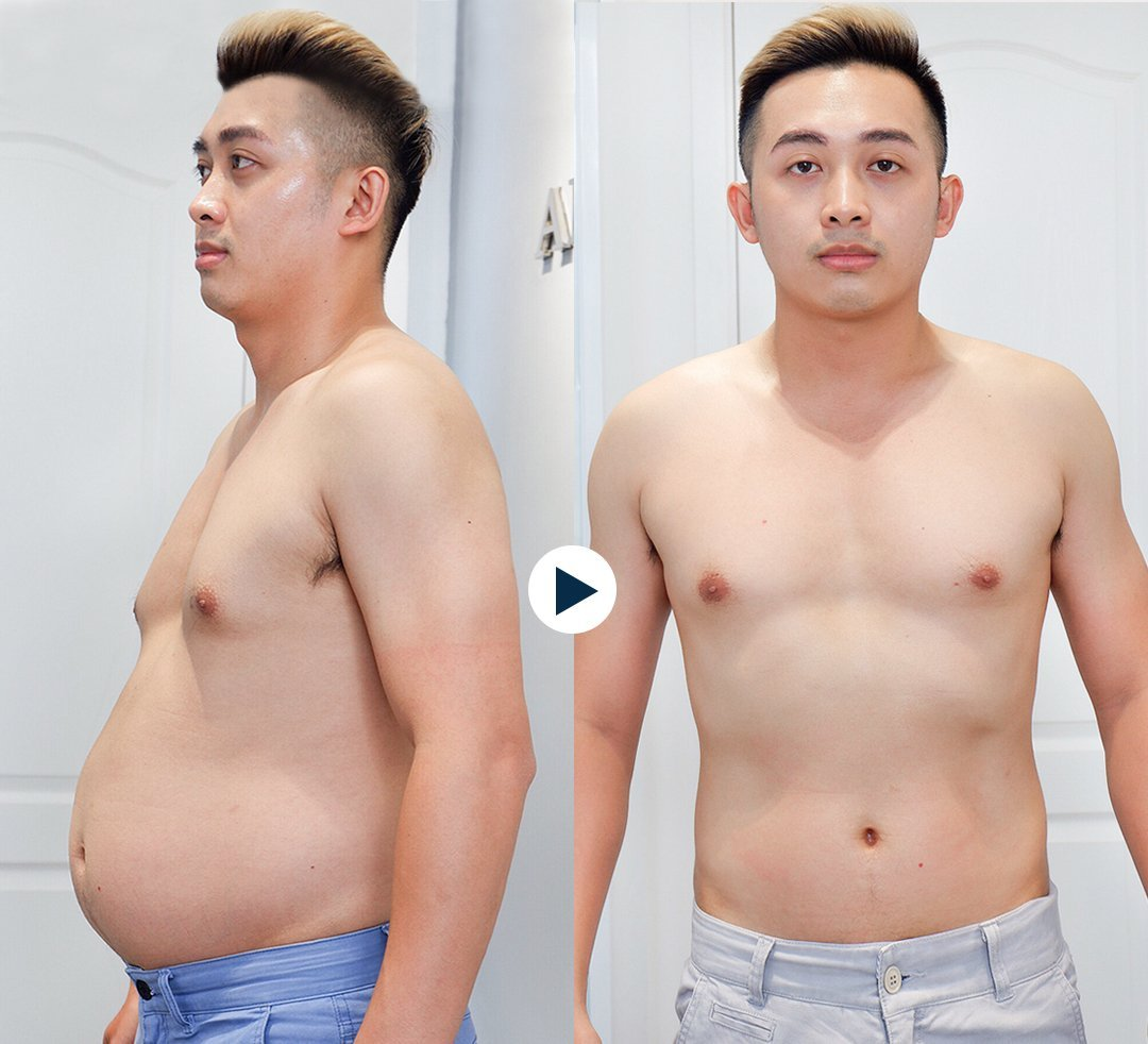 Hiệu quả khi áp dụng Giảm mỡ chuẩn Y khoa tại Americare Clinic