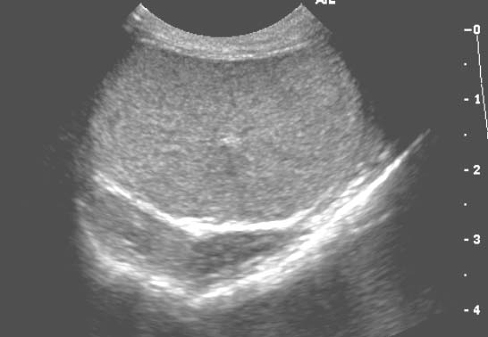 Normal scrotal sonogram in the transverse plane in a 6 year old Newfoundland with acute bacterial prostatitis