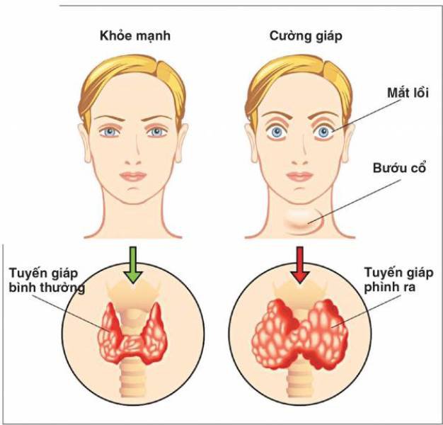 Bướu cổ, mắt lồi là triệu chứng điển hình bệnh cường giáp