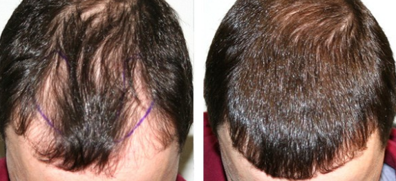 5 Reasons To Get A Revision Hair Transplant