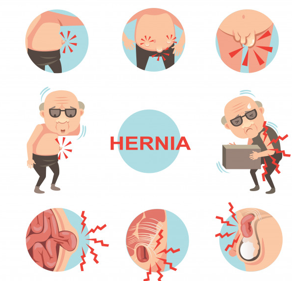 Vector image depicting pain resulting from hernia