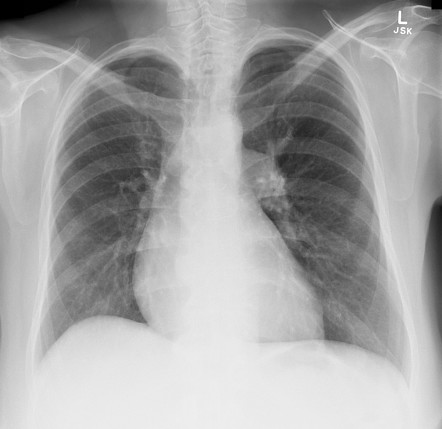 Figura 5 associada ao tromboembolismo pulmonar; Sinal de Chang. 