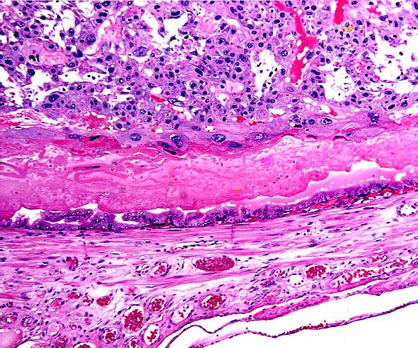 Floor at edge of placenta with giant cell layer separated by fibrinoid and serum from endometrium.