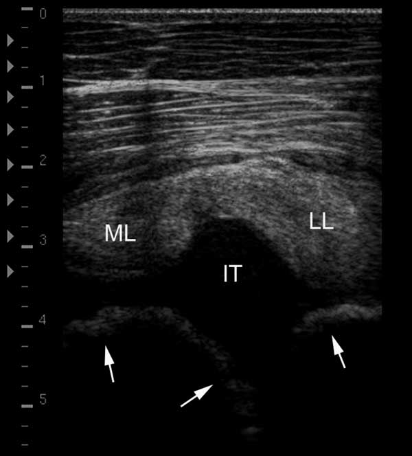 Normal appearance of medial and lateral lobes of the biceps tendon and proximal humeral tubercles in a 4 month-old foal