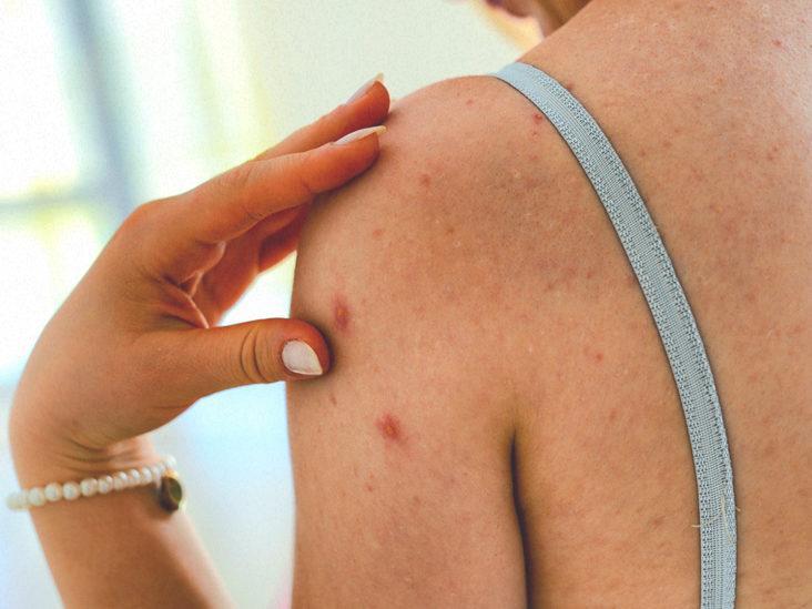 Shoulder acne solution at Da Vinci Clinic