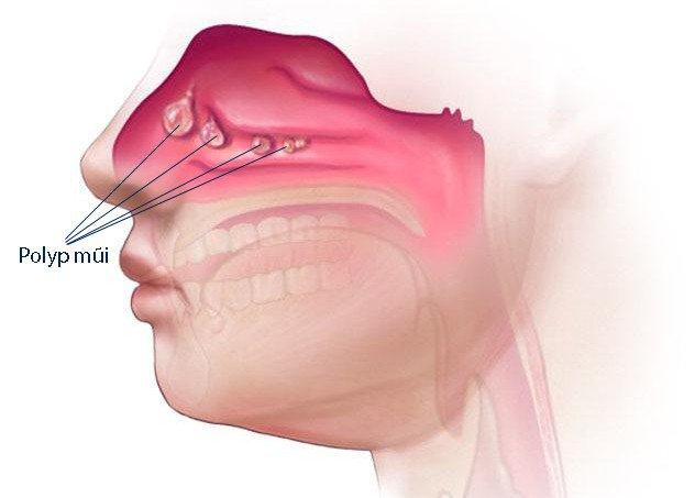 Viêm xoang lâu ngày có thể gây polyp mũi | Vinmec