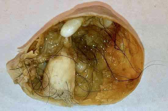 Teratoma: conheça os curiosos tumores que têm dentes e até cabelos |  Drauzio Varella