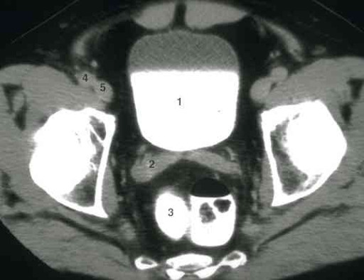 Aspecto tomográfico normal das vesículas seminais (número 2), imediatamente posteriores à bexiga  (número 1) e anteriores ao reto (número 3). A artéria ilíaca externa  é marcada pelo número 4 e a veia pelo número 5.