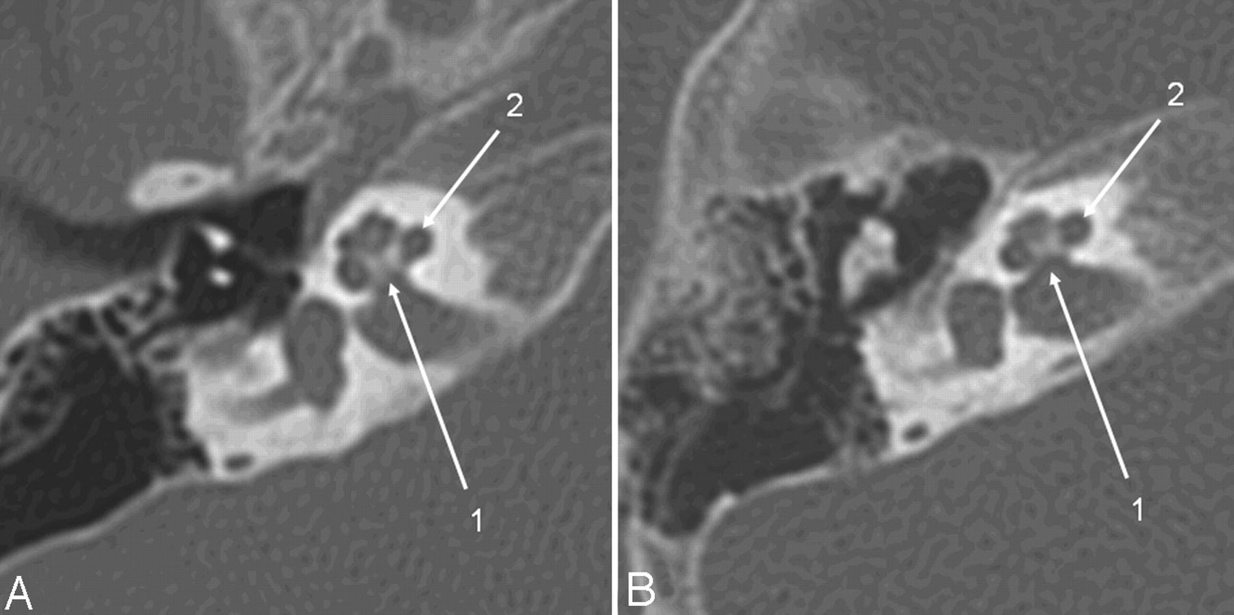 Temporal Bone Ct Anatomy