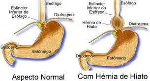 Dieta para Refluxo