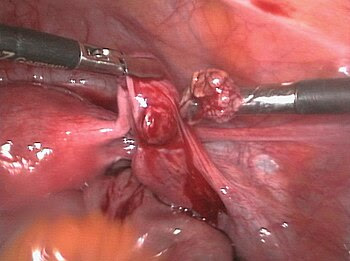 English: removal of an ectopic pregnancy out o...