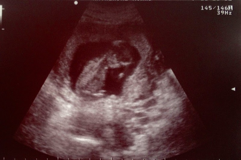 Baby #3 Ultrasound 1 2