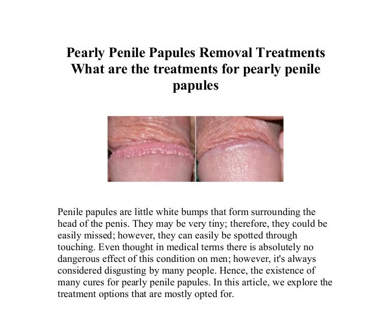 Papules penile severe pearly 3 Ways