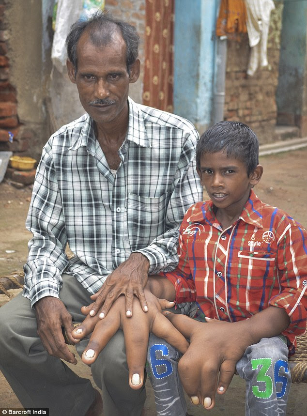 Kaleem's father Shamim, 45, (pictured together above) is worried his son will never become independent