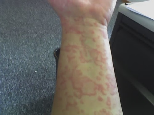 hives-in-children-urticaria-symptoms-and-treatment-for-parents-goodrx