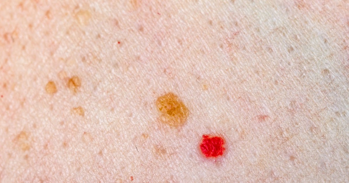 Red Spots On Skin Causes Diagnosis And Treatments Verywell Health